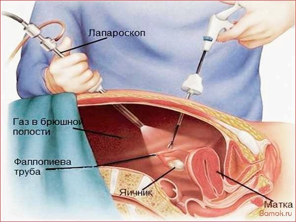 Лапароскопия органов малого таза — инновационный метод диагностики и лечения